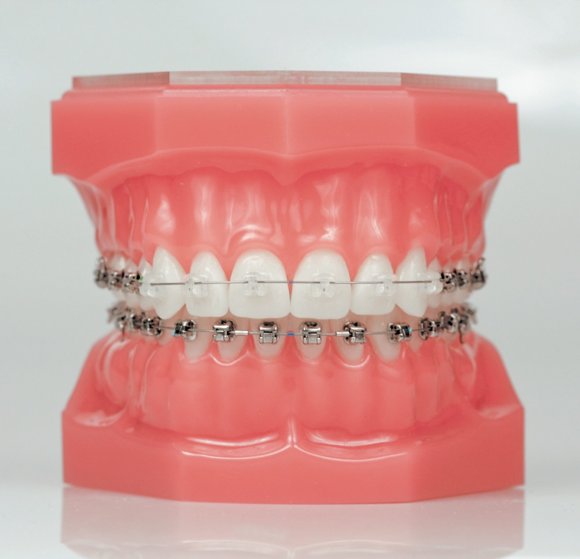 Willow Street Clear Braces
