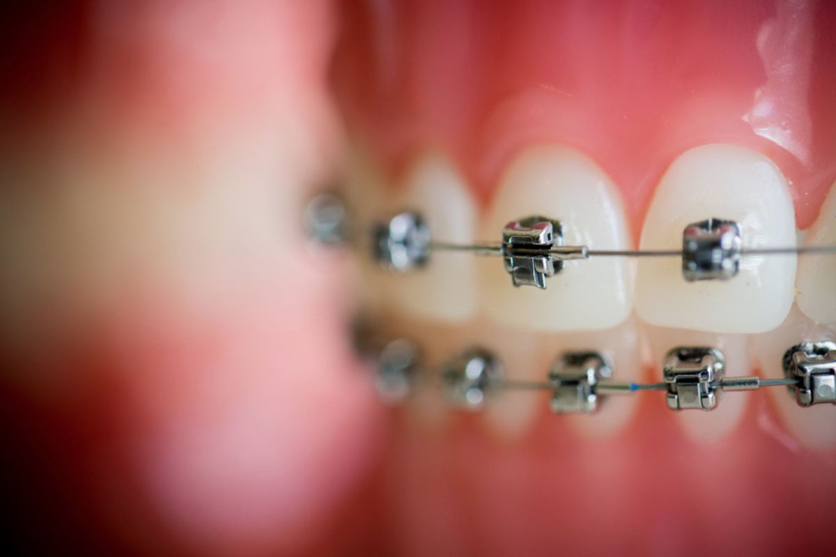Braces vs. Invisalign: Which One Is Right For Me?