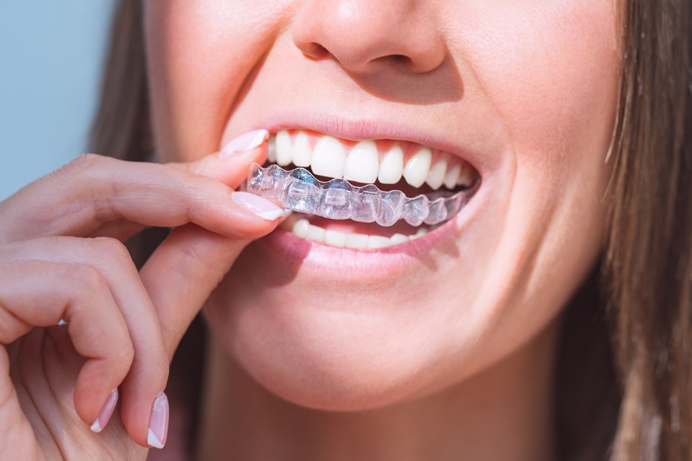 10 Unique Benefits of Invisalign at Howard Orthodontics in Willow Street, PA